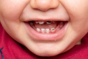 دندانپزشکی کودکان و اطفال در تهران