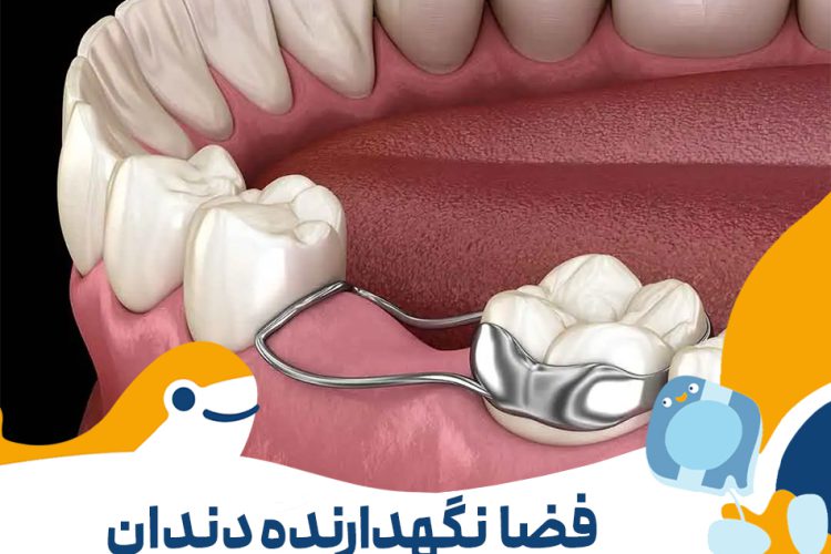 گذاشتن فضا نگه دار دندان کودکان در تهران
