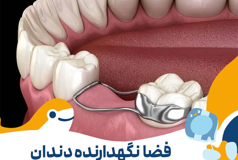 گذاشتن فضا نگه دار دندان کودکان در تهران