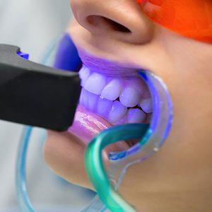 بهترین روش های سفید کردن دندان کودکان