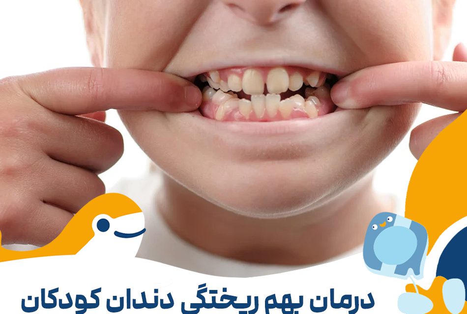 درمان بهم ریختگی دندان کودکان در تهران